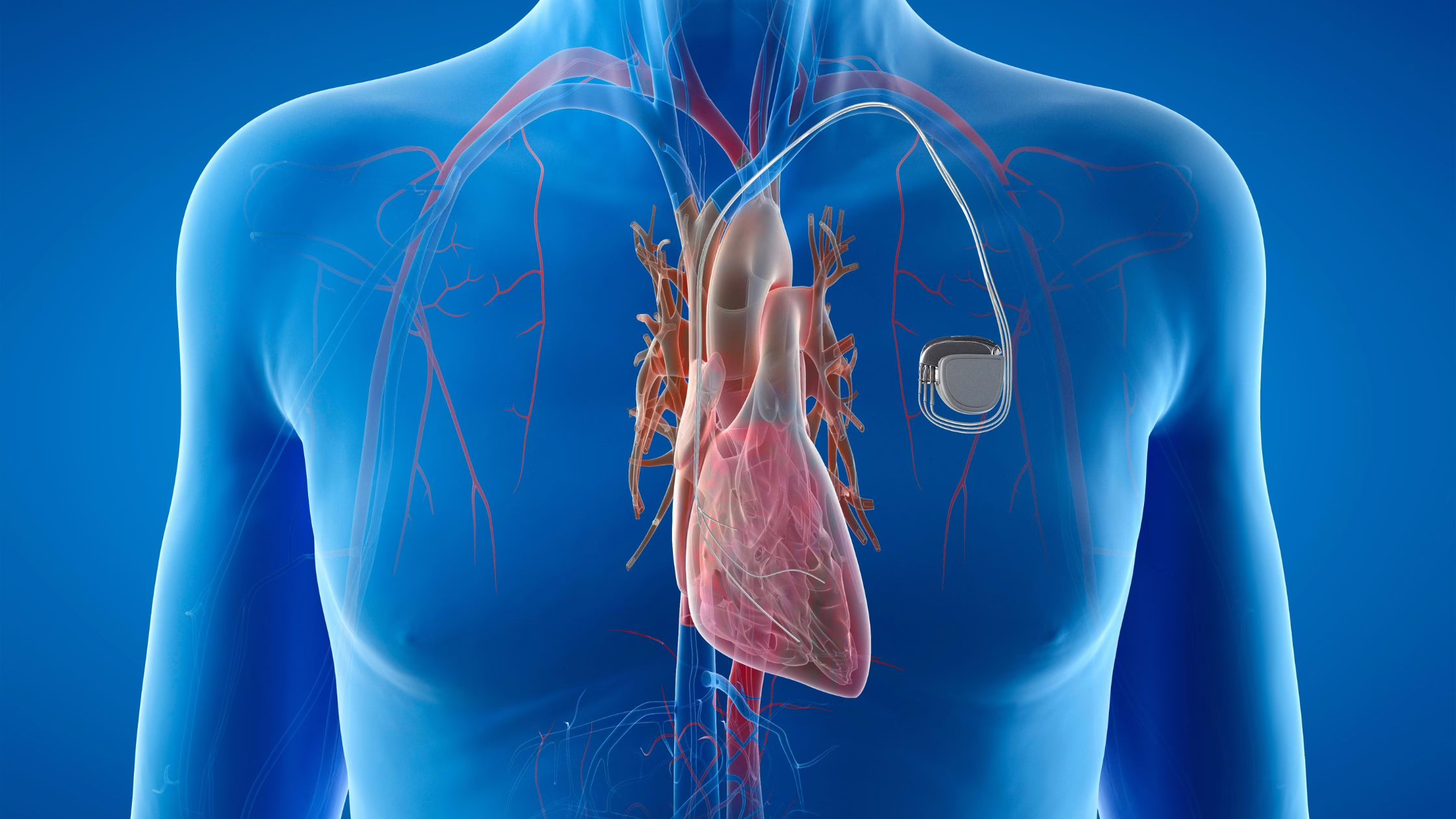 3D illustration of a heart with an artificial pacemaker implanted, showing internal anatomy.