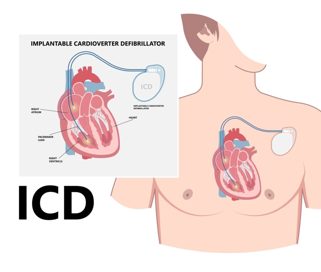 Defibrillator vs. Pacemaker: How to Choose the Right Device for Your Heart