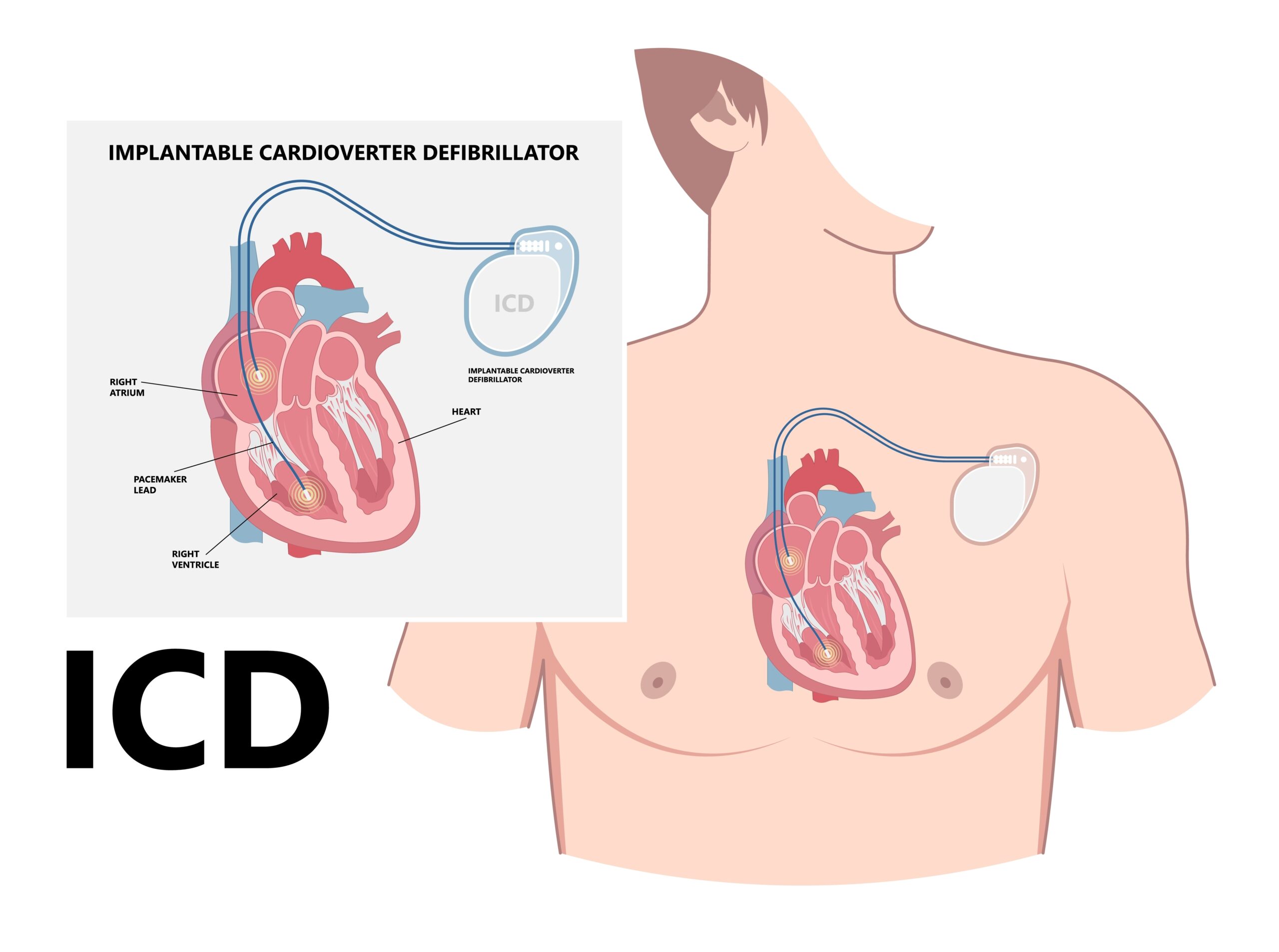What to Expect During Defibrillator Surgery ICD