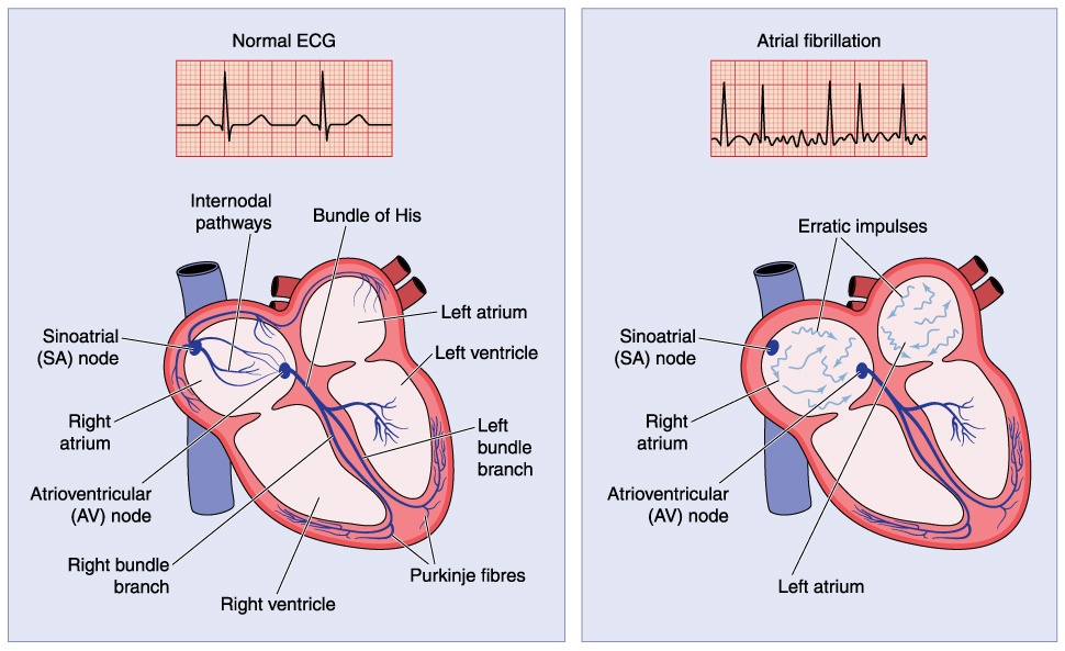 What Happens to the Body During Defibrillation - AED - Heart