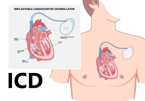 Pacemaker ICD Implantable Cardioverte Defibrillator Pulse Generator Stimulate of Heart Prevent Bradycardia Electronic Medical Device